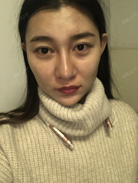 今天第二天了,打过溶解酶的泪沟和鼻唇沟更深了,眼圈_圈子-新氧美容