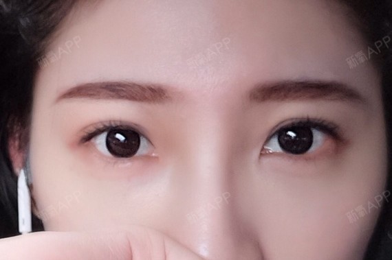 开外眼角好不好_效果图_xyyzxhdxm开外眼角术后第61天_新氧美容整形