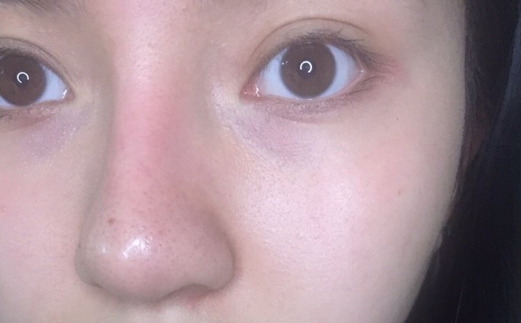 像这样鼻梁红红的,细看有小血丝