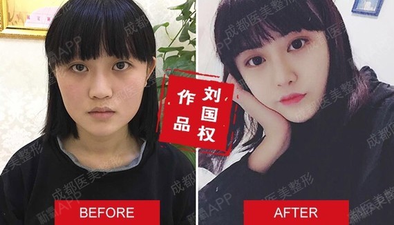 [成都医美整形医院]面若桃花,鼻子当家,综合性隆鼻_圈子-新氧美容整形