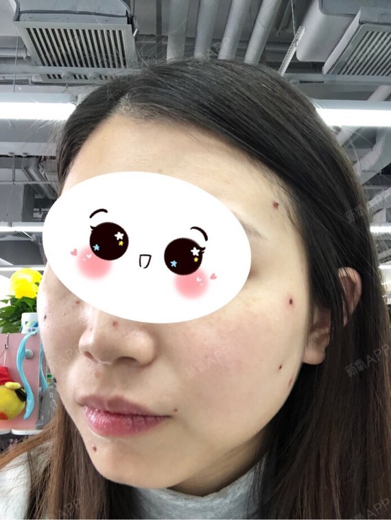 第四天,基本都结痂了,不敢吃刺激辛辣的食物,有的恢_圈子-新氧美容
