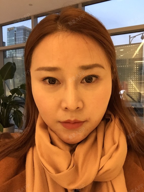 脸部填充脂肪后悔死了_脂肪填充脸部是大手术吗_脂肪填充全脸费用