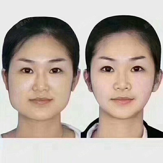 注射瘦脸好不好_效果图_苏雨呀注射瘦脸术后第0天_新氧美容整形