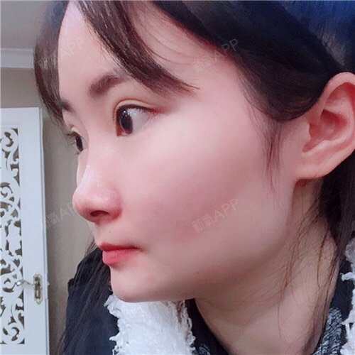 成都溶脂瘦脸好不好_效果图_南宫叶溶脂瘦脸术后第10天_新氧美容整形