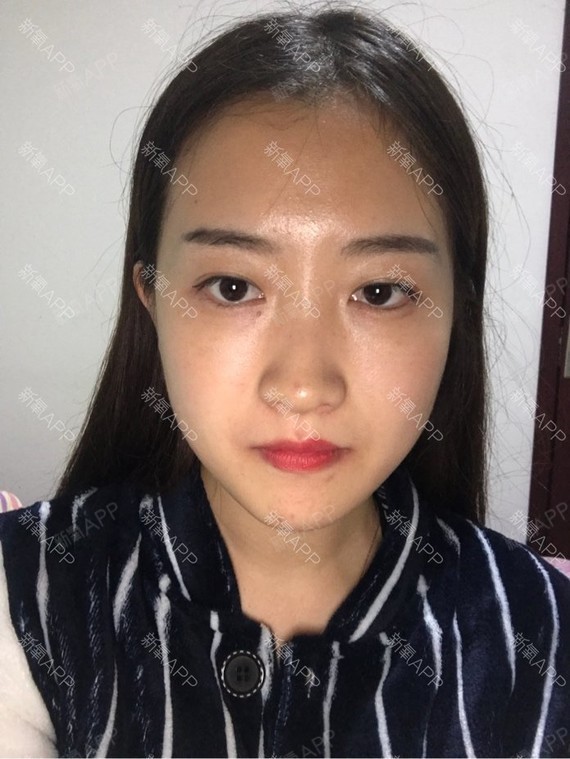 今天是打完瘦脸针的第十天了,确实是从第七天开始见效_圈子-新氧美容