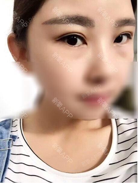 「精雕双眼皮术后第433天」2016年顾客眼部精雕_圈子-新氧美容整形