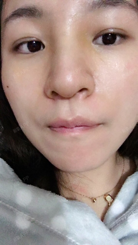 今天去拆了耳朵的线,还有鼻翼线,拆耳朵线不疼.