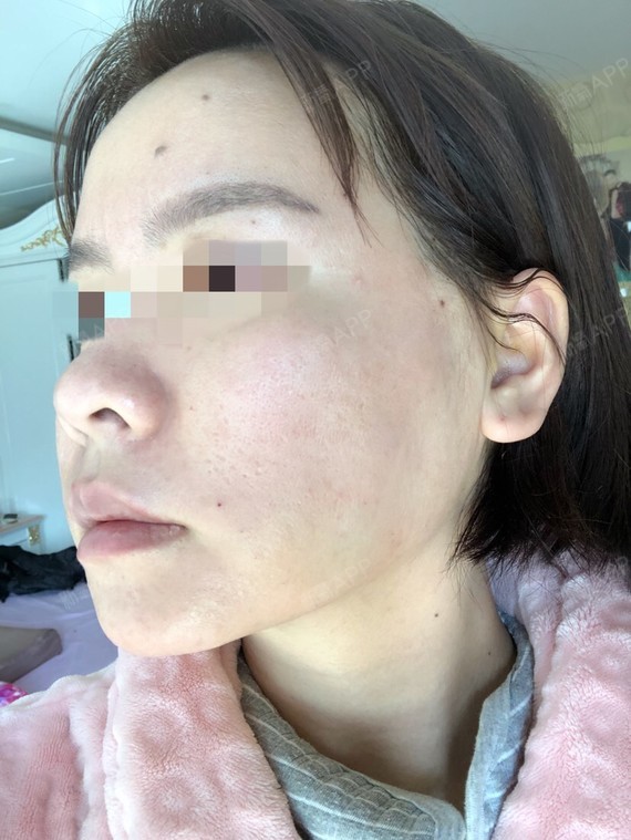 线雕术后第二天现在有些部位已经感觉不到线的拉扯感了效果不错我最