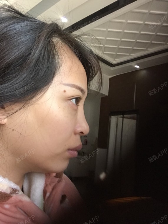 鼻背低注射玻尿酸好还是线雕隆鼻更好?