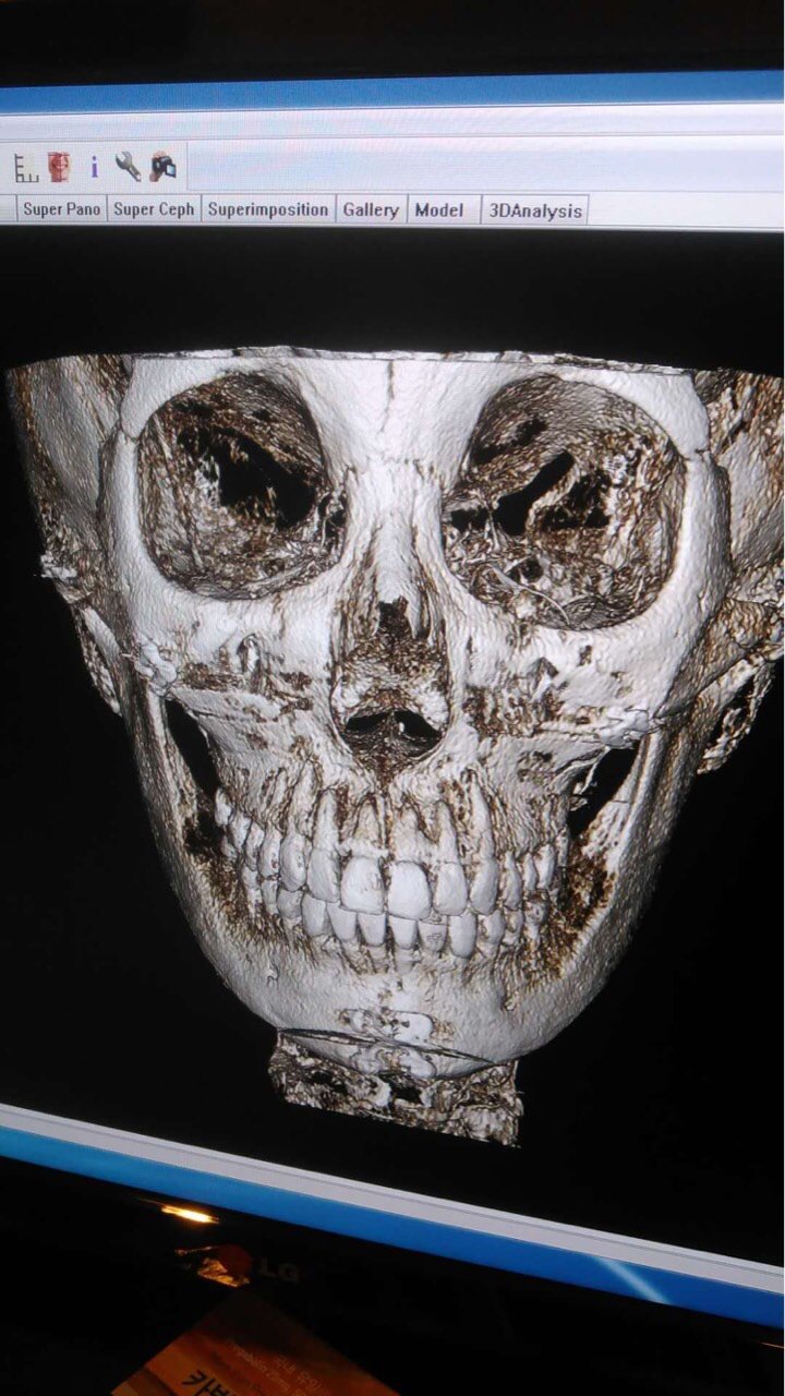 颧骨颧弓整形术第28天