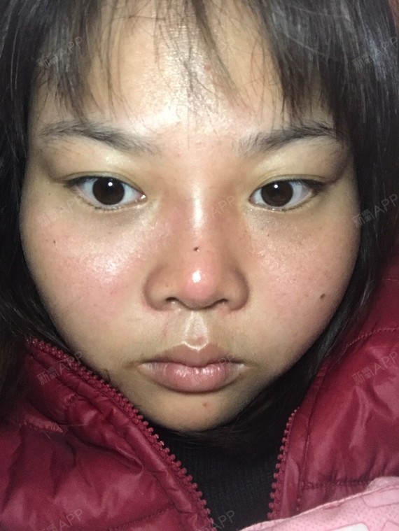 鼻头特别的异常,颜色红的,很突兀