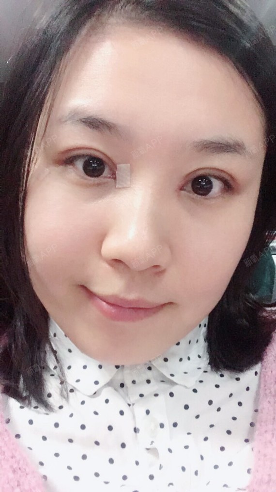 切开双眼皮