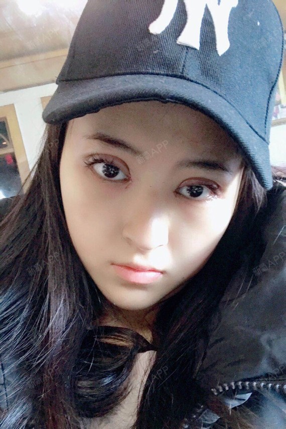 今天是刚做完双眼皮后的第三天了,双眼皮还很肿很肿,_圈子-新氧美容