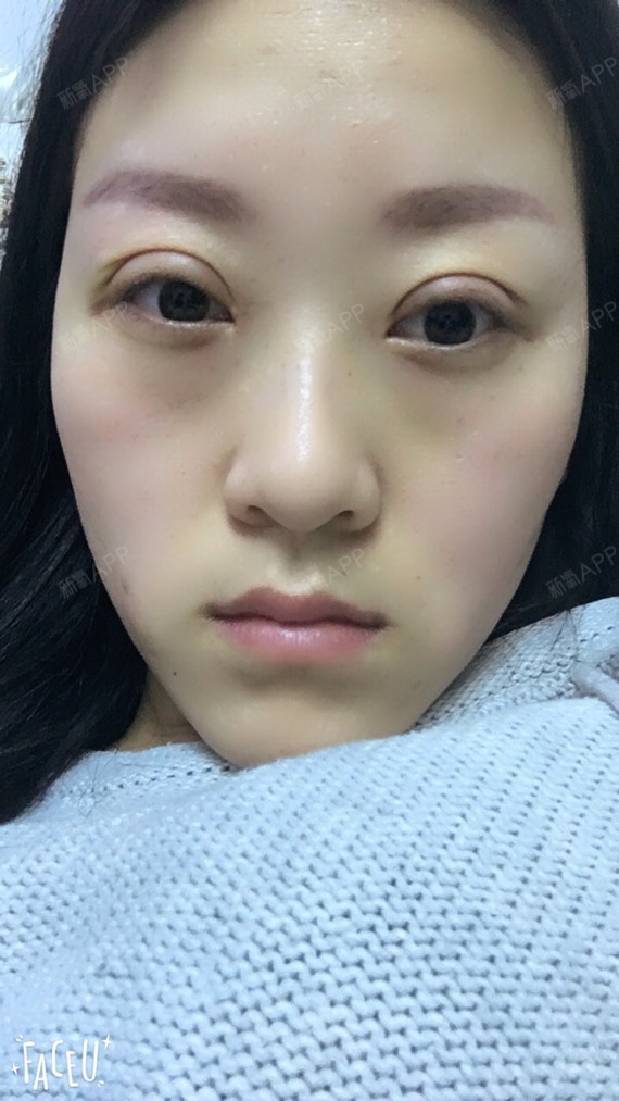 新氧- 氧气2798341513597698 | 眼部 | 开眼角 | 双眼皮 | 开内眼角