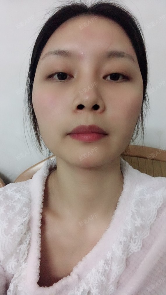 我是今年的7月份打了一次瘦脸针的,然后感觉咬肌又出_圈子-新氧美容