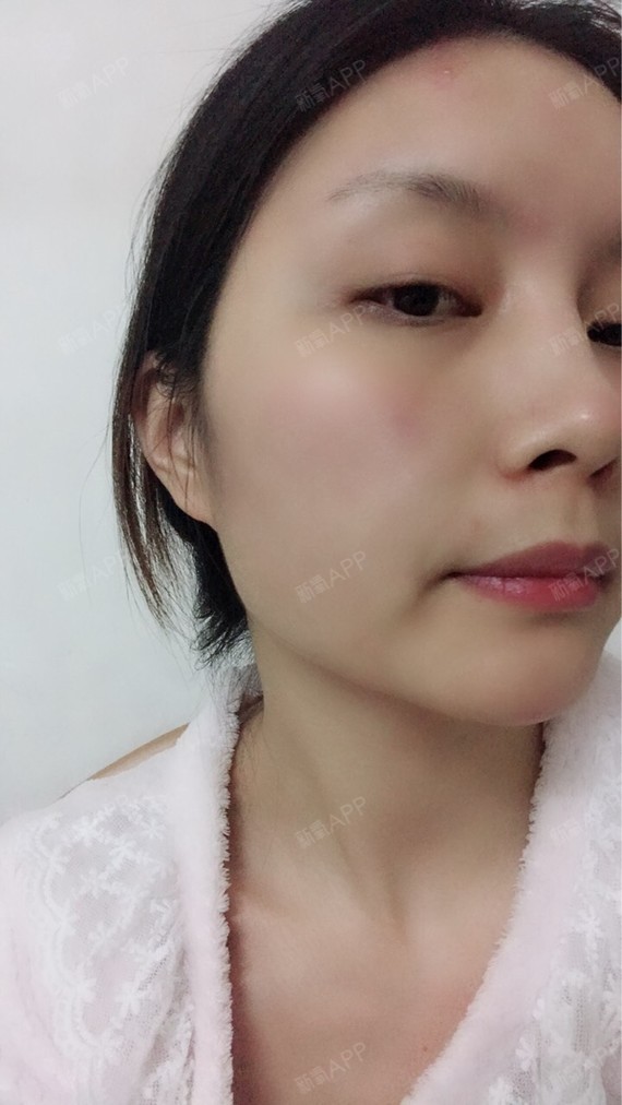 我是今年的7月份打了一次瘦脸针的,然后感觉咬肌又出_圈子-新氧美容