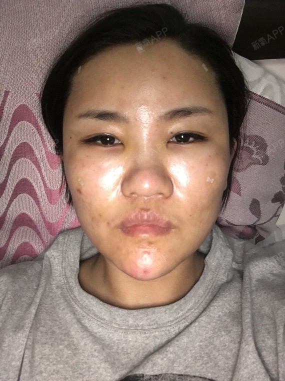 鼻梁,内眼角特别肿,我想问问有没有和我一样的,后来好了的亲