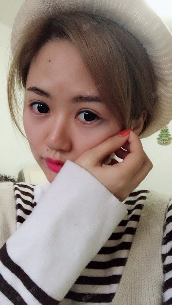 打了卧蚕,这都2天了,还这么肿,怎么办啊,什么时候_圈子-新氧美容整形