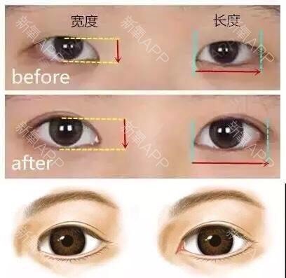 "内眦赘皮"是指在内眦角前方的一片垂直的皮肤皱襞,_圈子-新氧美容