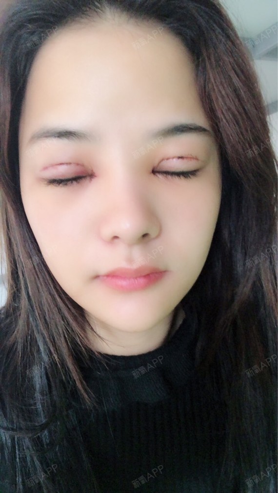 我的眼睛属于肿泡眼,一直都想解决这个问题,平时化妆都是要帖双眼皮贴
