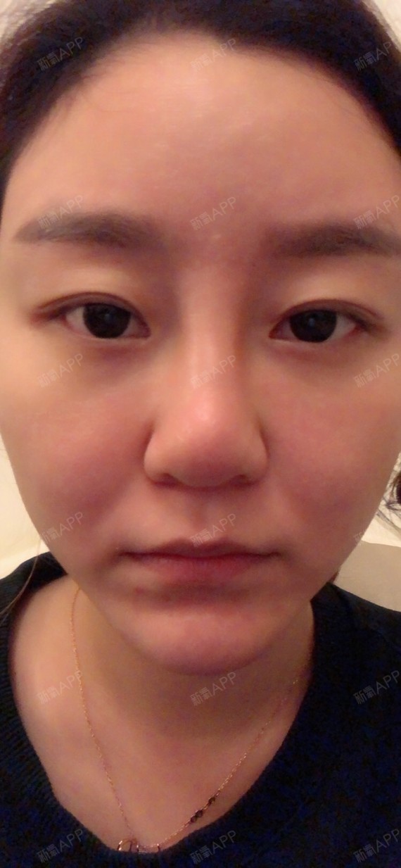 我想改善鼻头以前喜欢挤痘痘所以鼻头很肉但是我不想用_圈子-新氧美容