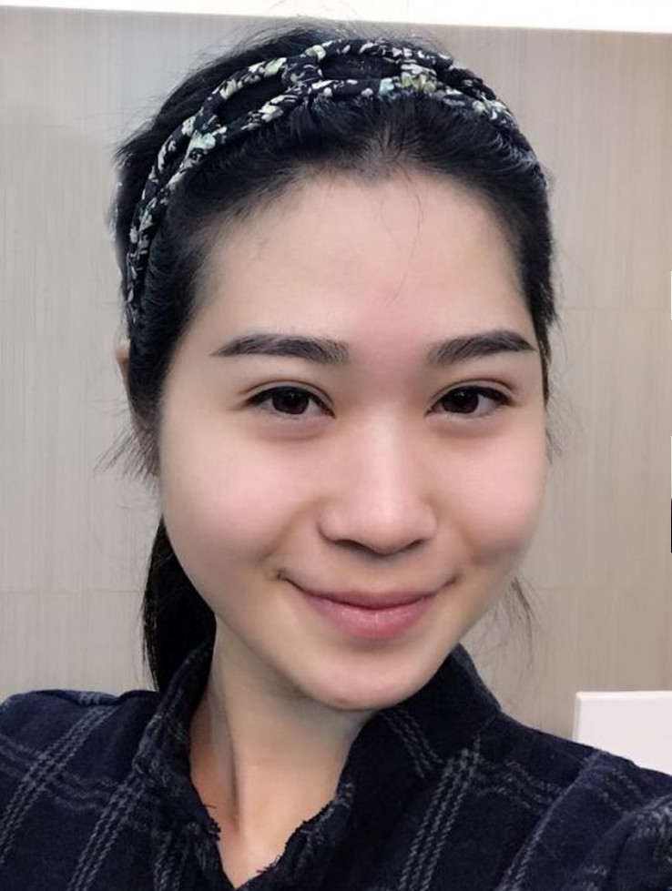 温州美域高医疗美容自体脂肪丰额头怎么样_恢复过程_效果如何_ins少女