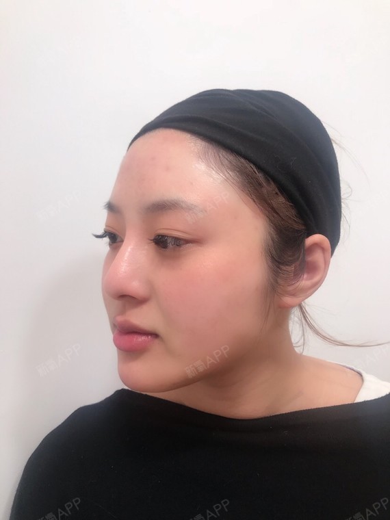 上海玻尿酸丰额头好不好_效果图_大可可9595玻尿酸丰额头术后第1天_新