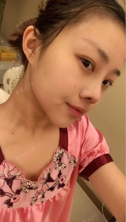 深圳肋软骨隆鼻好不好_效果图_huargn肋软骨隆鼻术后第9天_新氧美容