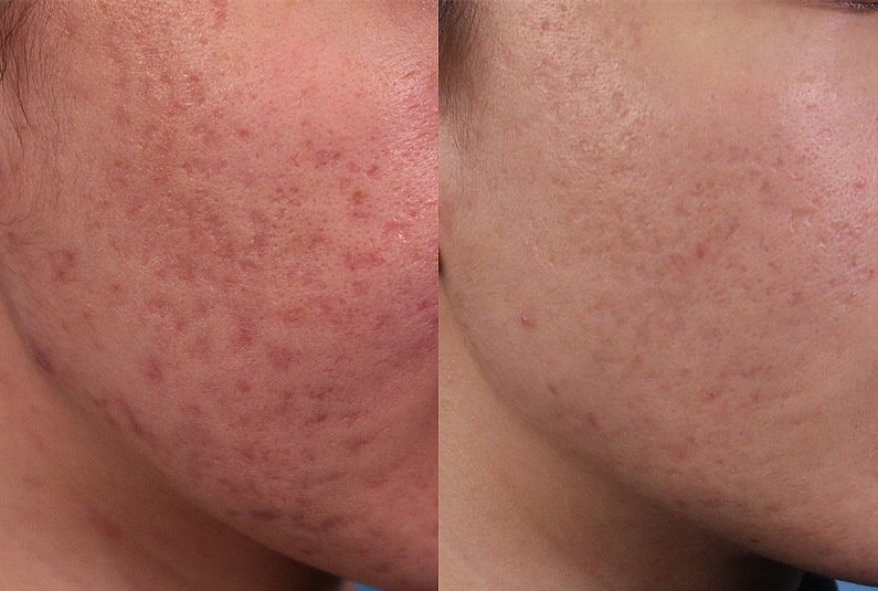 必须说说这个皮秒激光治疗痘坑肌心得分享给大家