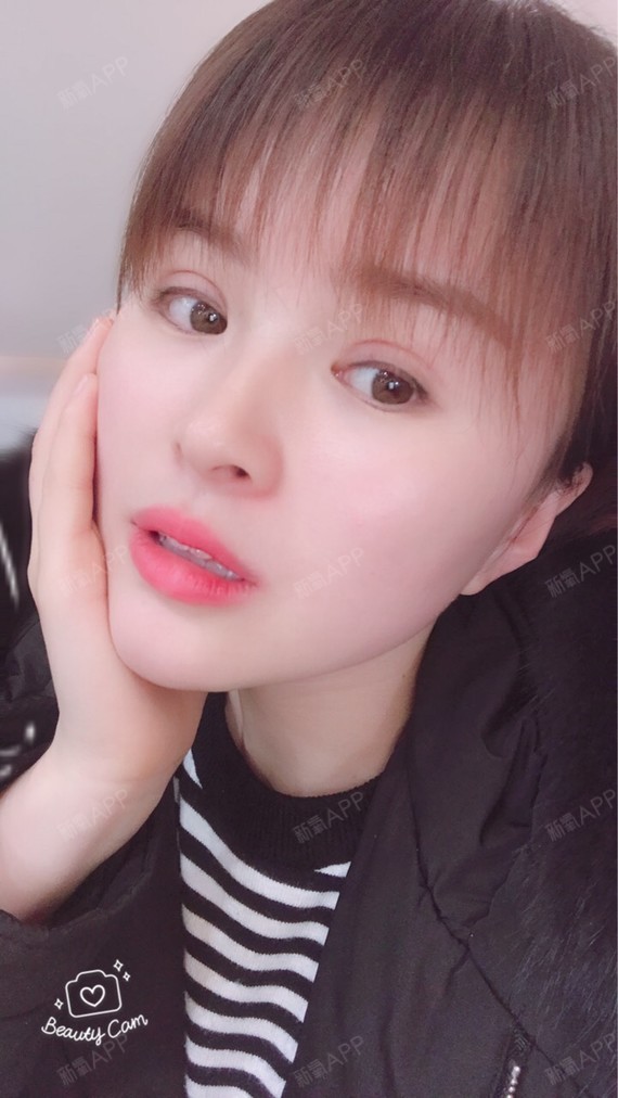 郑州美岚整形自体脂肪填充术术后第三十一天 人家说 圈子 新氧美容整形