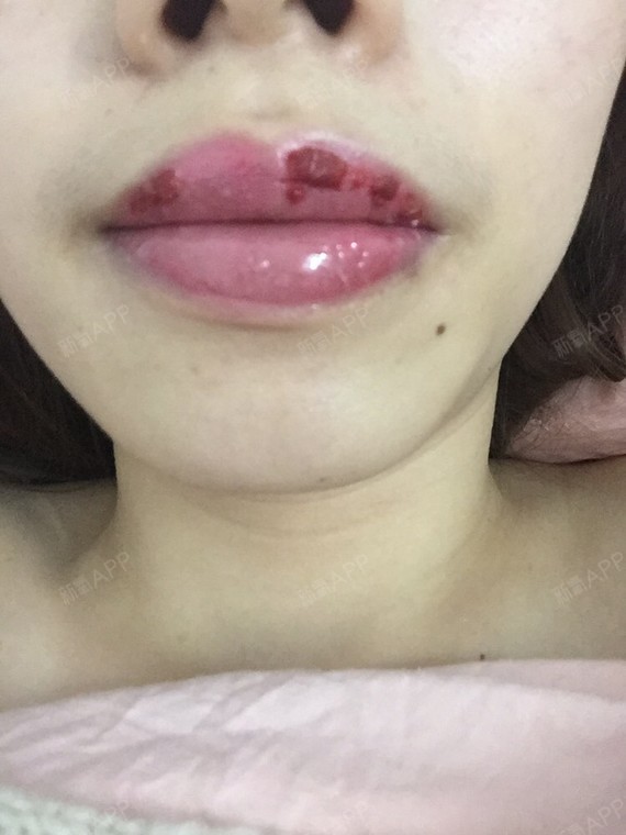 水晶唇恢复七天过程图图片