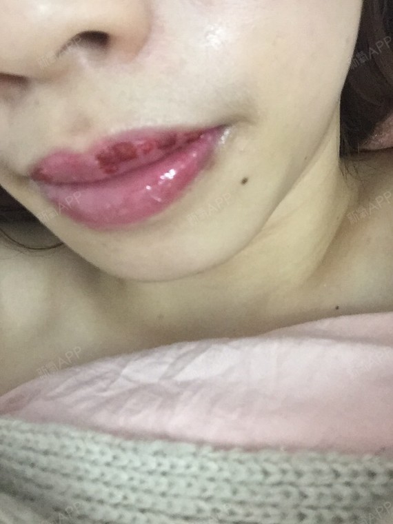 水晶唇恢复七天过程图图片