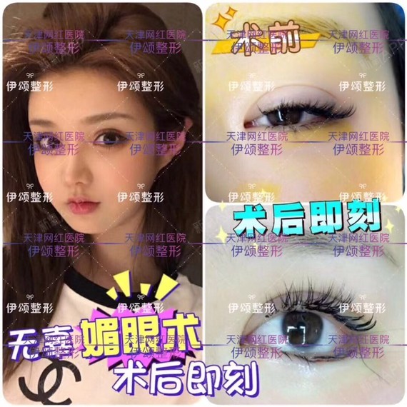 外眼角下至术后即刻效果,变大立竿见影眼尾延长并且往_圈子-新氧美容