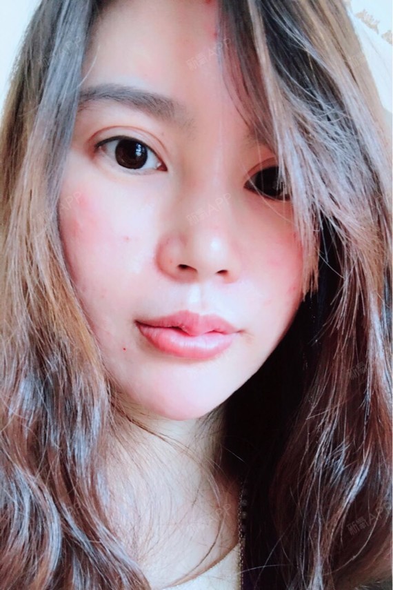 郭可乐昕昕厚唇改薄第15天美丽日记-新氧美容整形