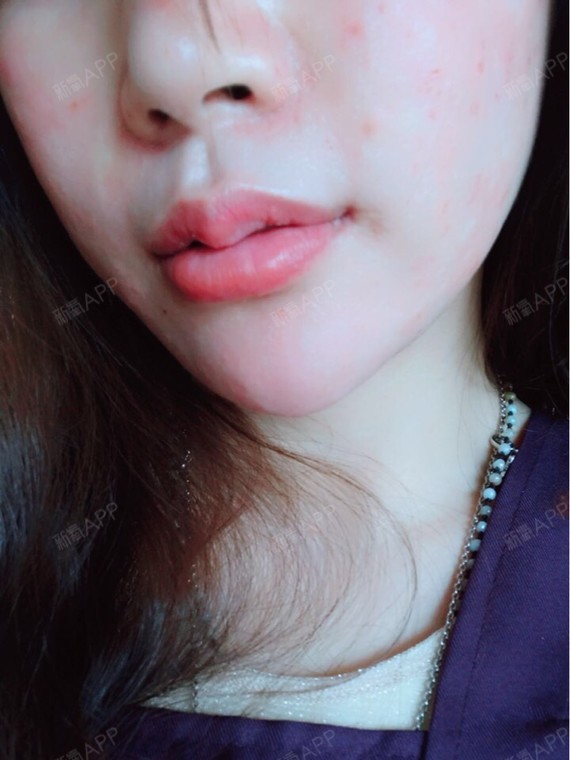 厚唇 | 薄唇 | 厚唇组织切除术 | 玻尿酸丰唇 | 自体脂肪丰唇 | 微