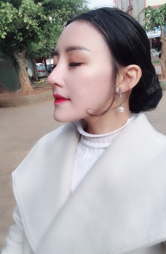 新氧- 阿瑶啊 | 鼻部 | 面部轮廓 | 隆鼻 | 术后当自强 | 国内整形