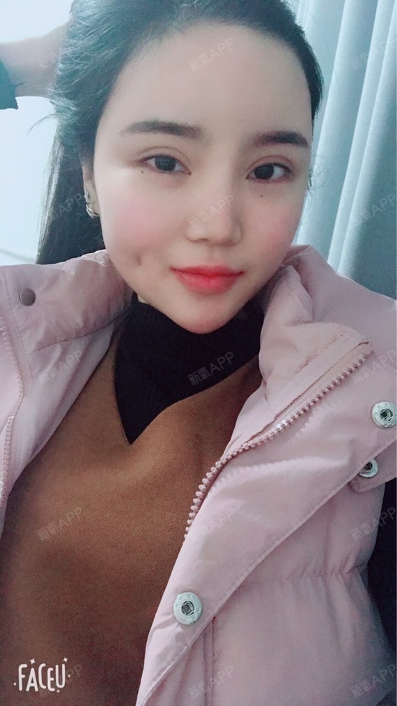 今天第七天了包括手术那天第八天本来想今天在当地拆线_圈子-新氧美容