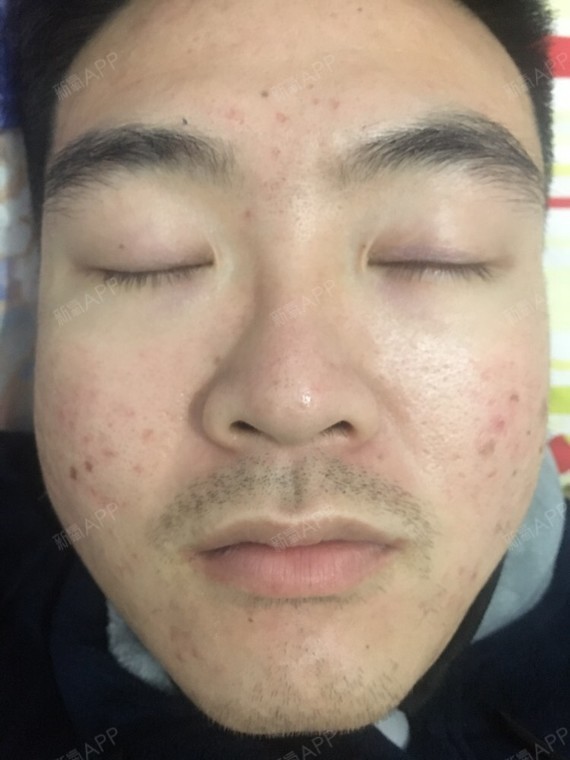 像素激光第五天脸部部分结痂已经脱落,未脱落的集中在_圈子-新氧美容