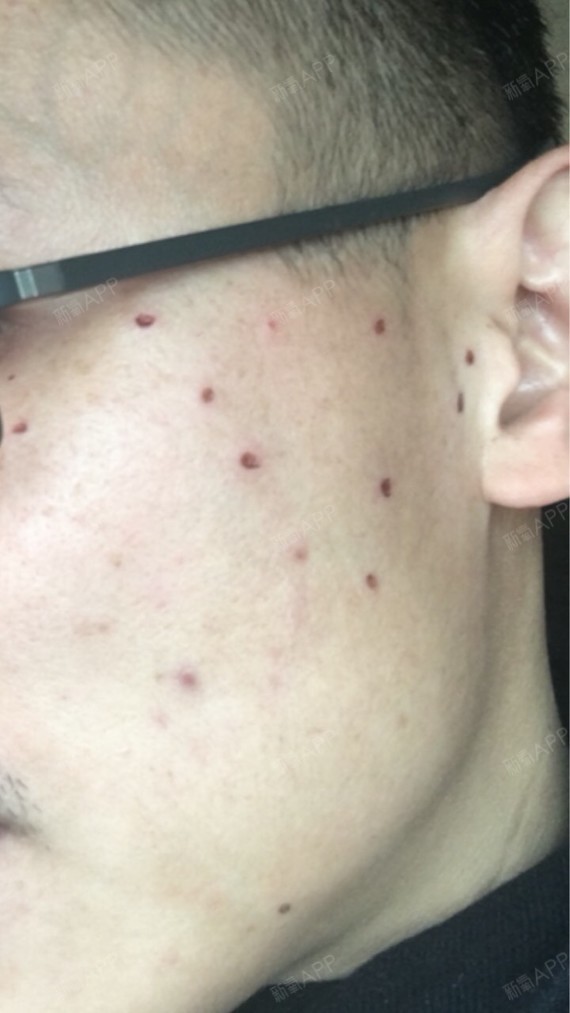 新氧- 空中飞鱼9 | 激光美肤 | 皮肤 | 术后当自强 | 激光点痣 | 北京