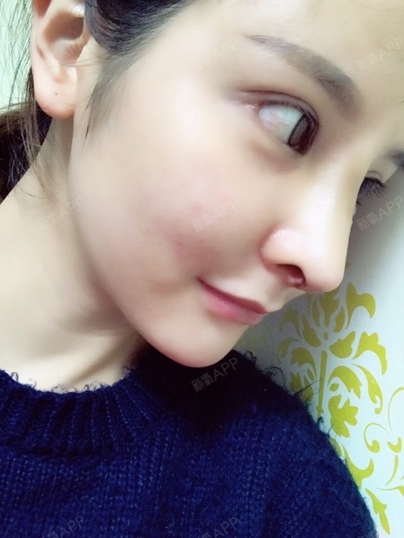 来自非洲的大美女硅胶隆鼻第11天美丽日记