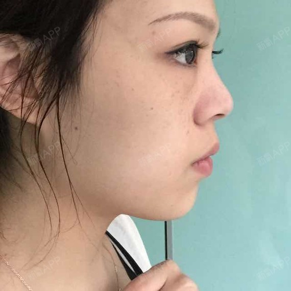 注射完1个月了,侧面视觉效果还是很好的,比以前饱满_圈子-新氧美容