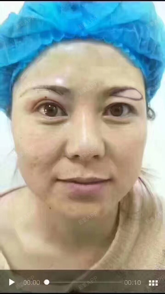 提眉又称韩式悬眉,与切眉手术是不同的,提眉术是将眉_圈子-新氧美容