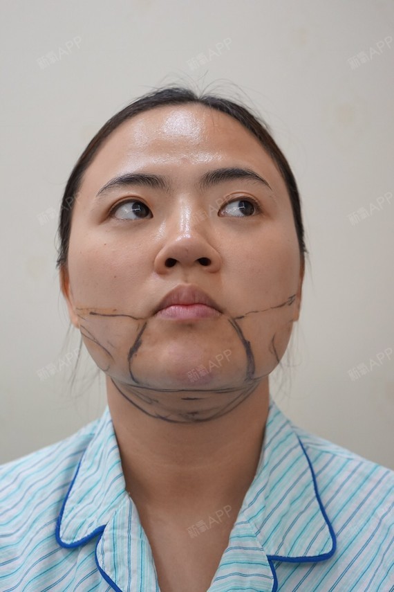面部吸脂的适应证是什么？