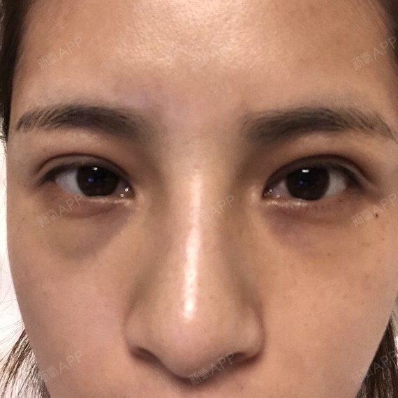 双眼皮手术失败医生没有经过同意动了上睑提肌导致一边_圈子-新氧美容