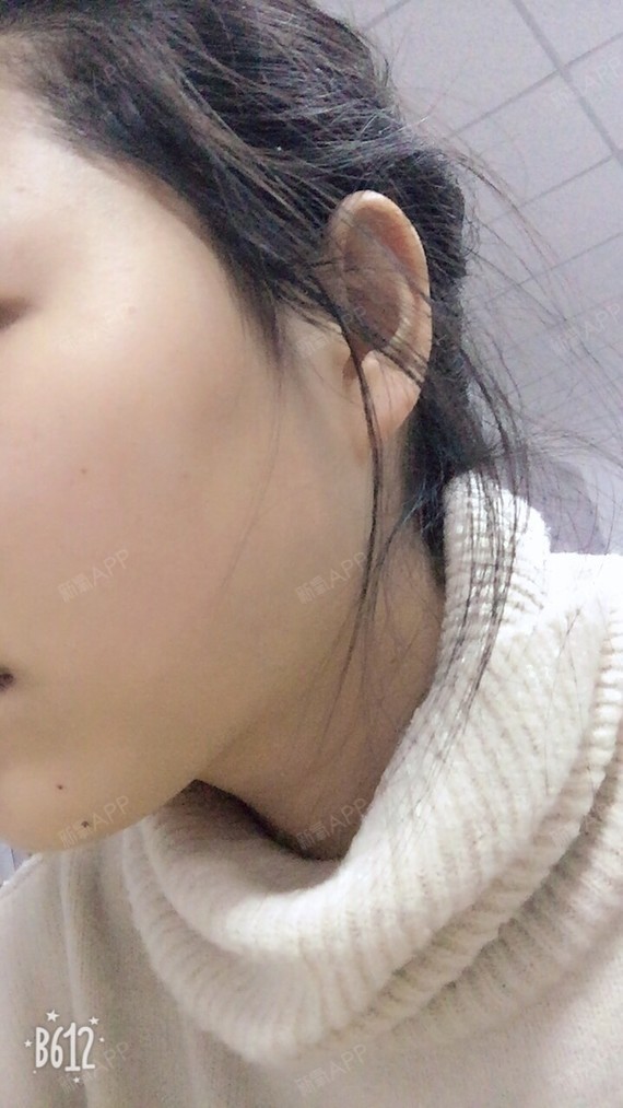 今天第三天,咬肌还有点肿的感觉,偶尔会有酸酸胀胀的_圈子-新氧美容