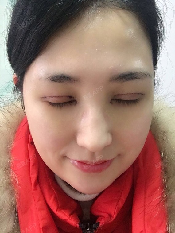 眼部 | 面部轮廓 | 开眼角 | 开内眼角 | 切开双眼皮 | 术后当自强