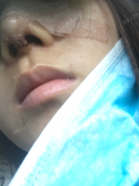 做了鼻部多项,鼻小柱伤口处起了两个泡,是为什么