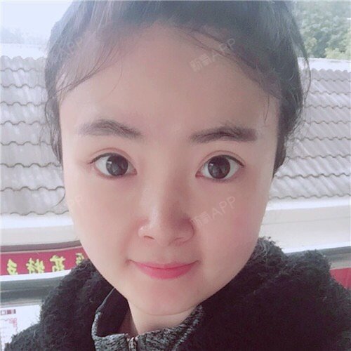 【溶脂针双下巴第三次术后第28天】