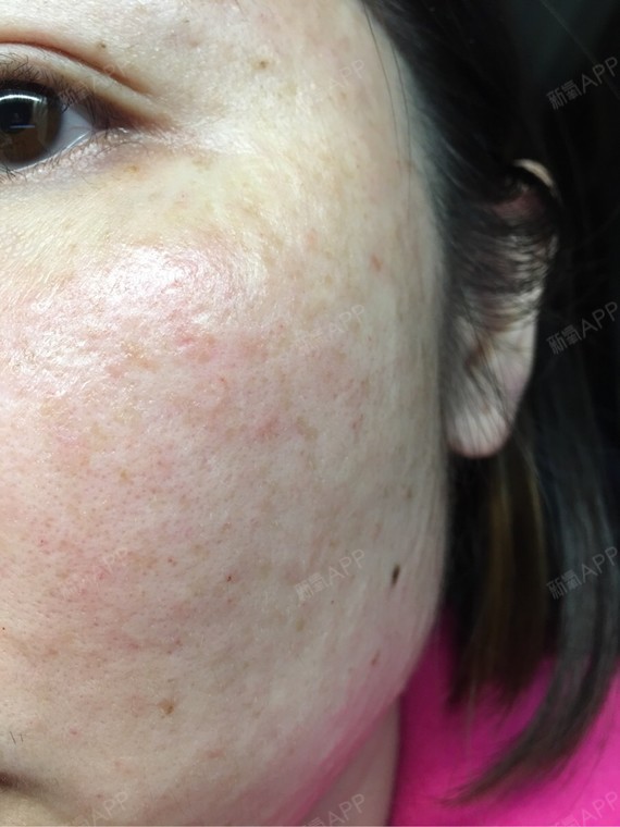 麻药敷好了,需要自己清理清洗,服务一般吧,我每年都会打3-5次水光针