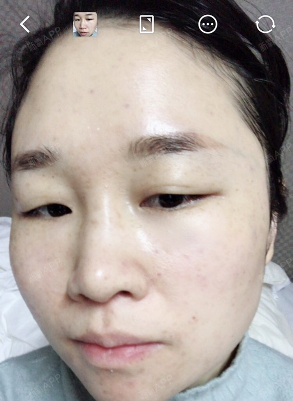 上海水光补水好不好_效果图_糜安白水光补水术后第7天_新氧美容整形